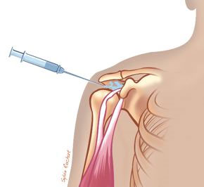 Traitement de la bursite à l'épaule par infiltration de glucocorticoïdes cortisone