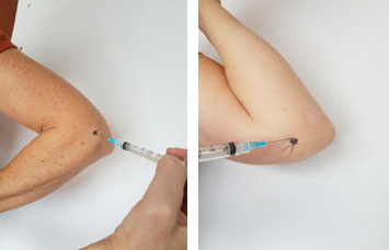 Traitement pour le tennis elbow par infiltrations locales de glucocorticoïdes cortisone