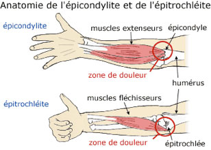 Épicondylite-interne