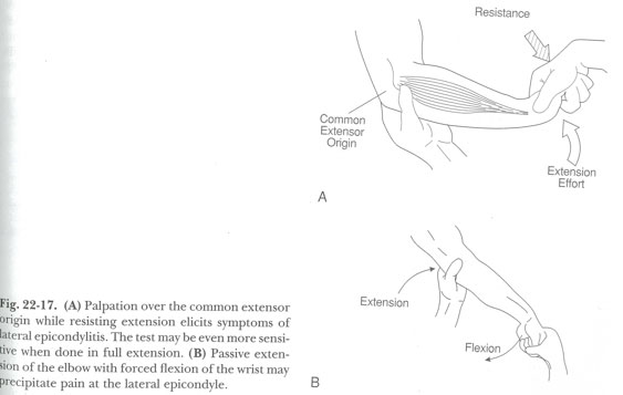 Traitement pour le tennis elbow par la manoeuvre de Mills