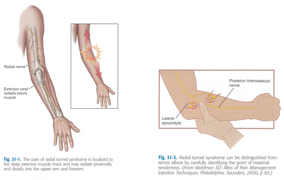 Explication de l'épicondylite résistante