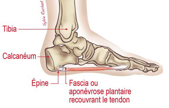 Diagnostic de l'épine de Lenoir ou fasciite plantaire