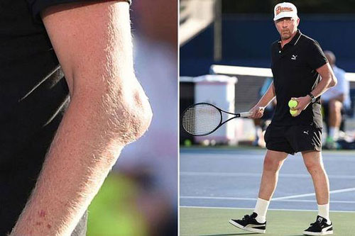 Bursite du coude de Boris Becker