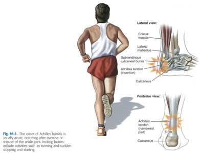 Diagnostic de la tendinite Achiléenne
