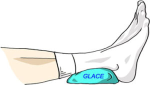 Traitement tendinite Achiléenne par glaçage
