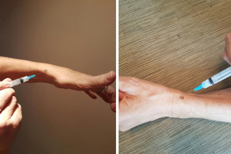 Traiter la tendinite de De Quervain par infiltrations de glucocorticoïdes cortisone