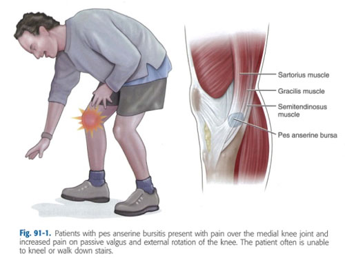 Explication de la bursite de la patte d'oie