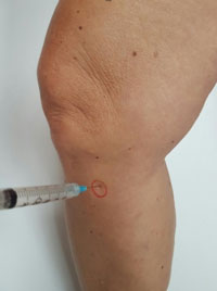 Traitement de la bursite du genou par infiltrations de cortisone